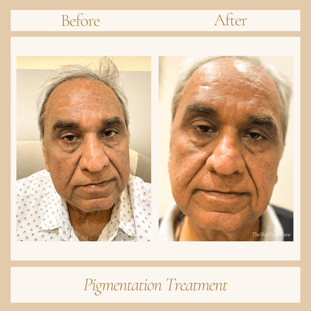 Pigmentation