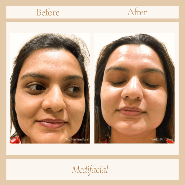 Medifacial