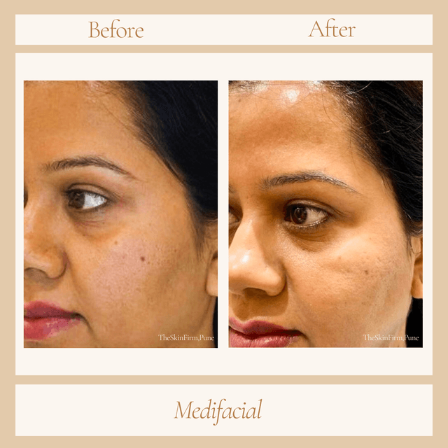 Medifacial