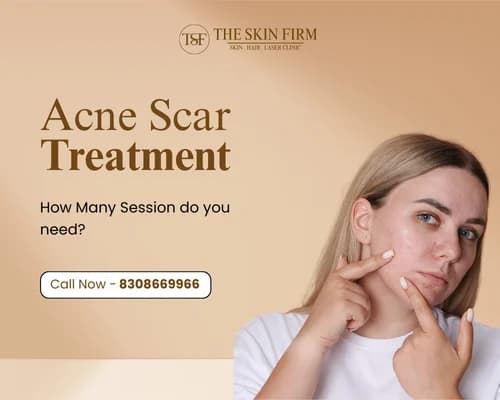 acne scar treatment