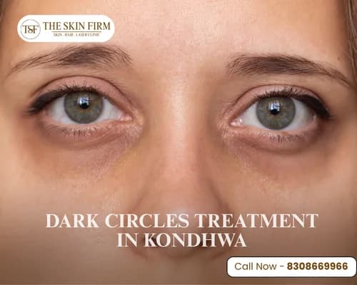 dark circle treatment in Kondhwa
