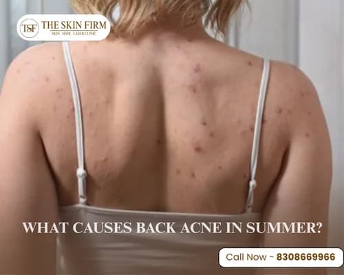 back acne 