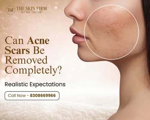 acne scar 