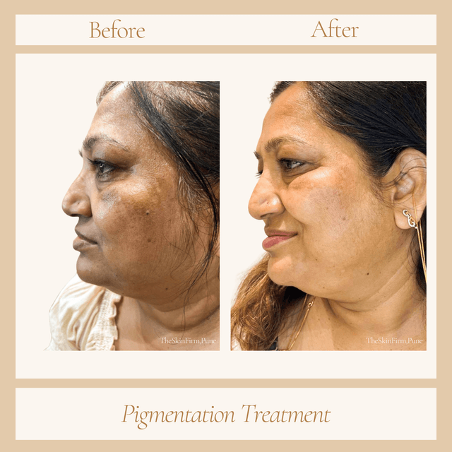 Pigmentation