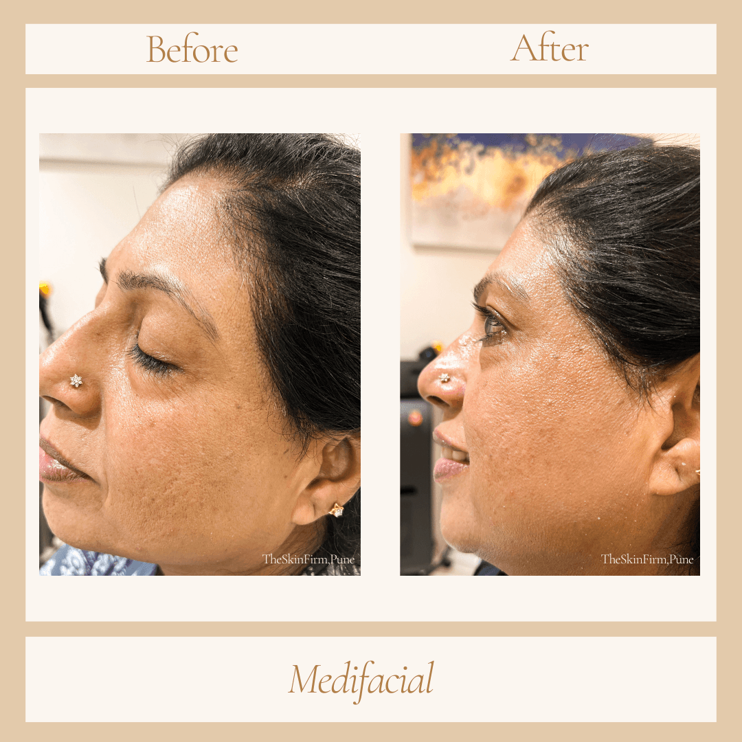 Before and After Transformation 4