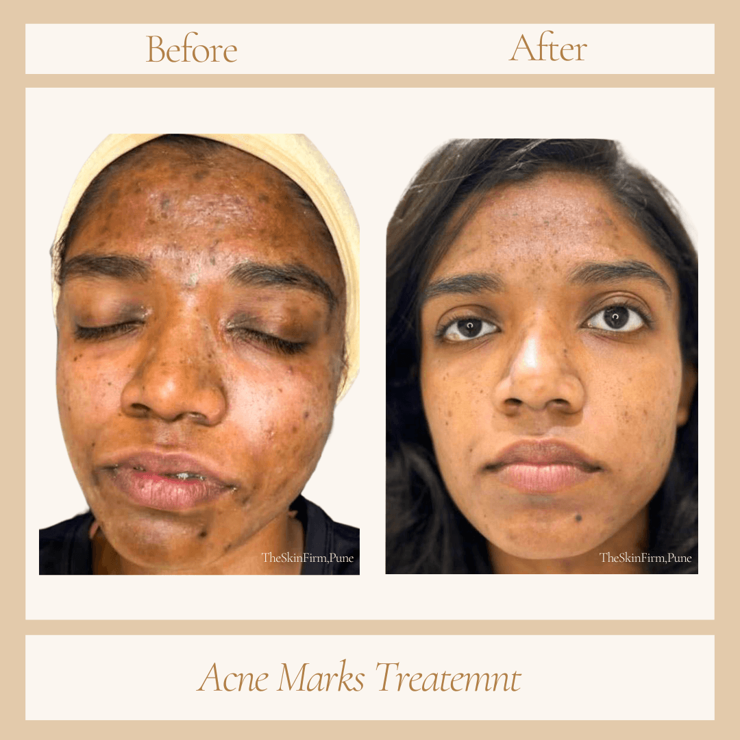 Treatment 4