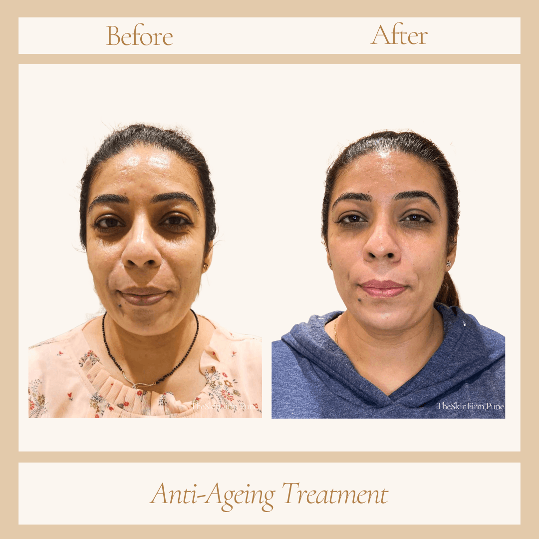 Treatment 5