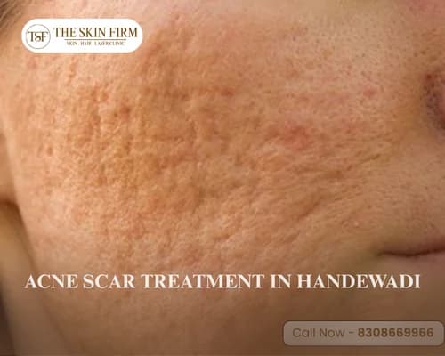 acne scar treatment in Handewadi