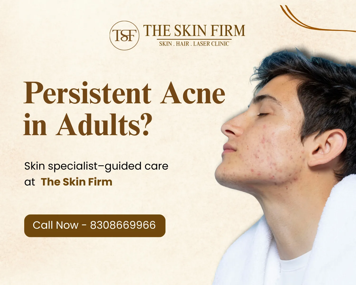 Persistent Acne in Adults