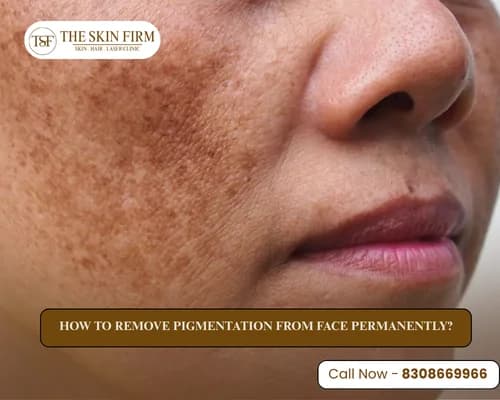 Pigmentation treatment in Pune