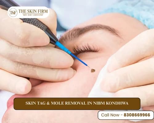 Skin tag and mole removal in NIBM Kondhwa