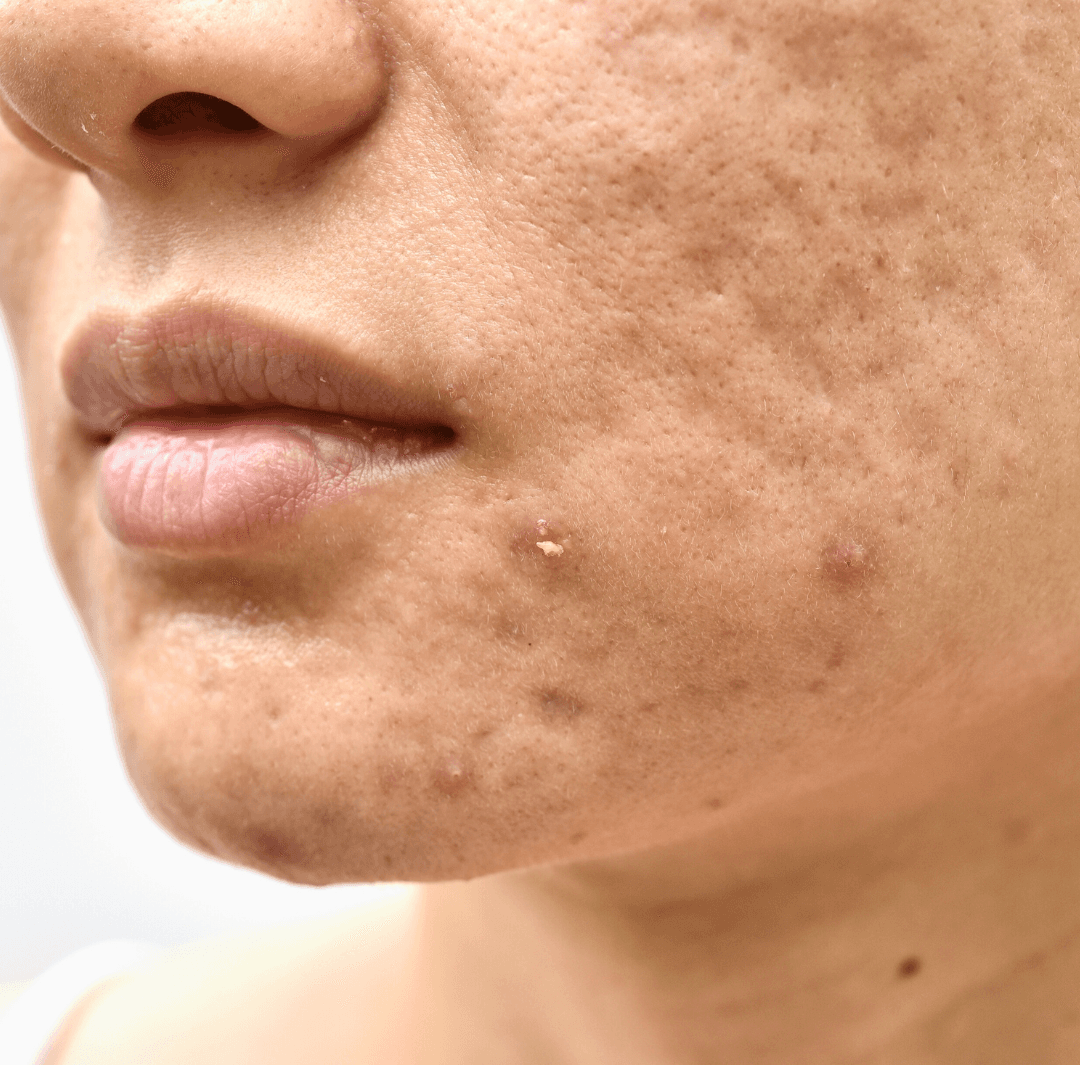 Acne Scars & Marks Treatment