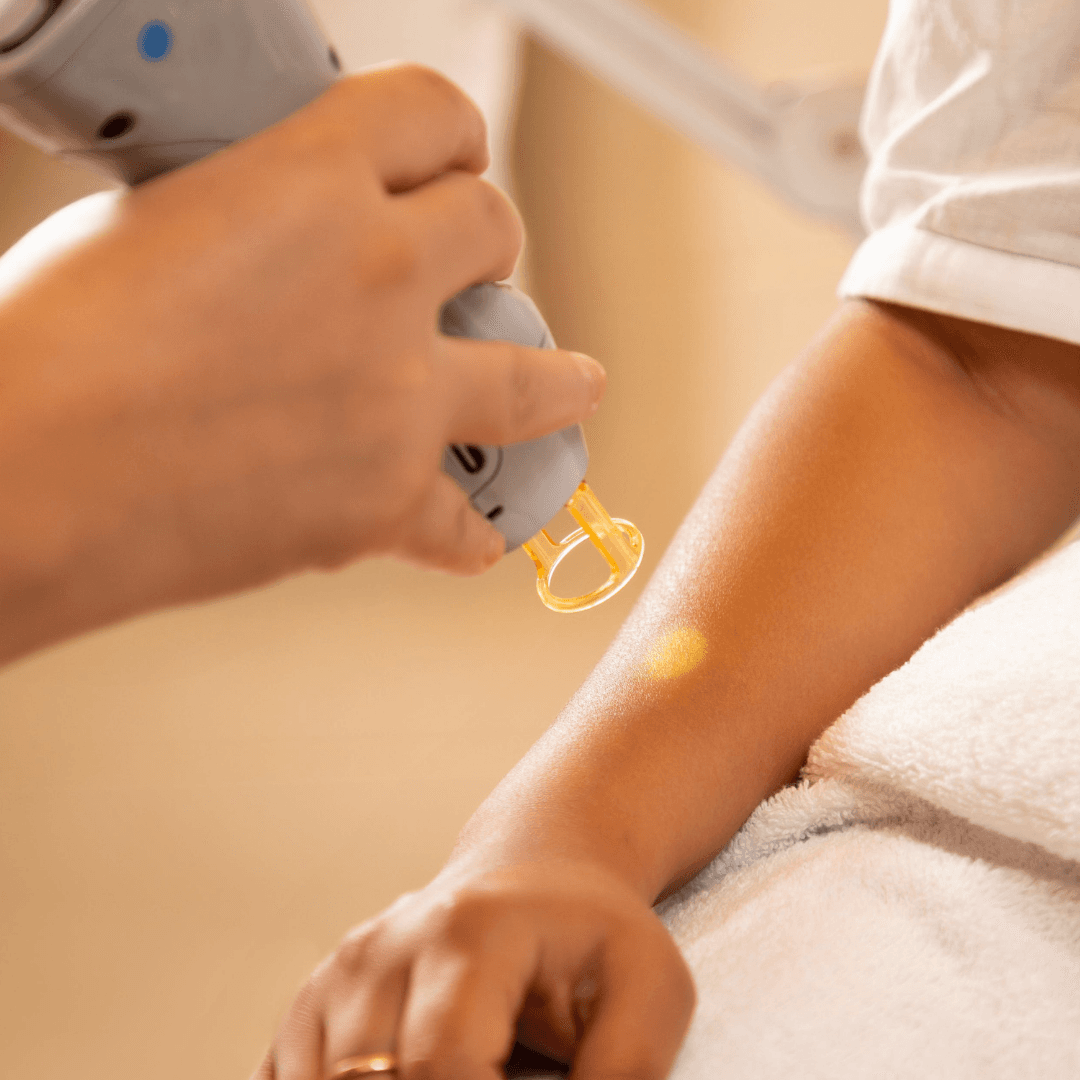 Diode Laser Hair Removal