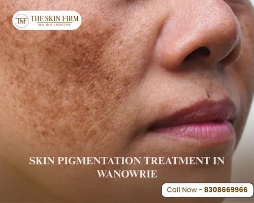 pigmentation treatment in Wanowrie