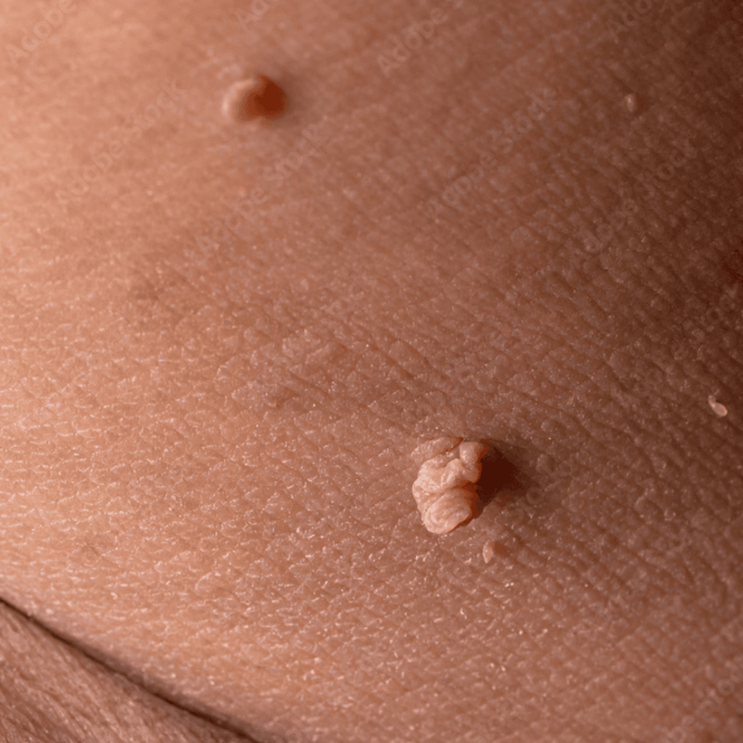 Mole & Skin Tag Removal