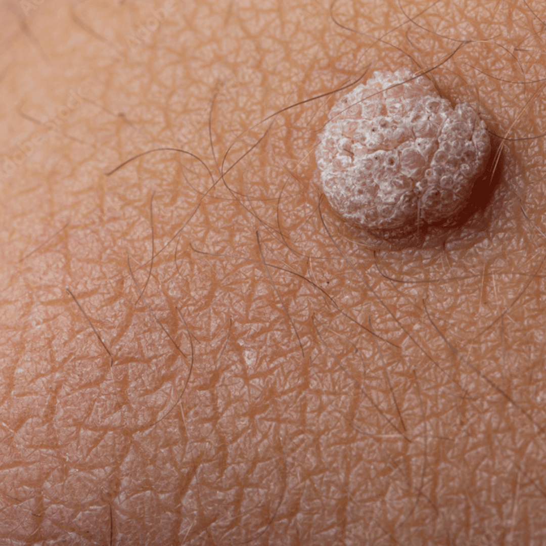 Wart Removal
